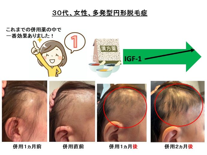 円形脱毛症　病院